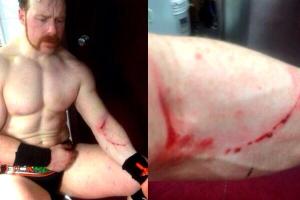 sheamus lesion
