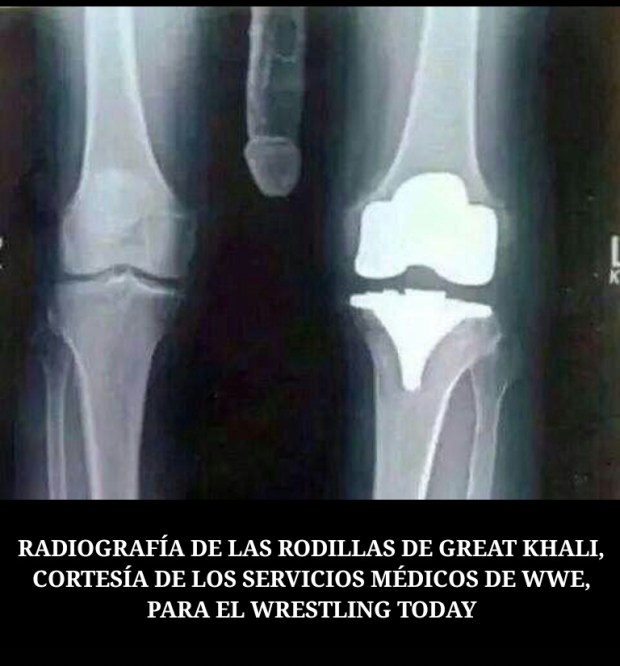 RADIOGRAFIA GREAT KHALI